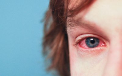 Is there a Relationship Between LASIK and Eye Allergies?